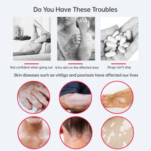 YOUWEMED 311nm Ultraviolet Phototherapy Instrument use UVB Lamp UV for Vitiligo Psoriasis White Spots Skin Disease